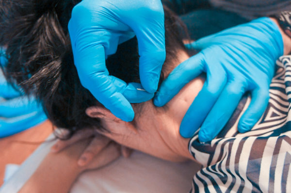 GARY KEARNS : DRY NEEDLING